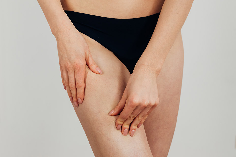 Cellulite e rimedi naturali: contrastarla sia dall’interno che dall’esterno con gli estratti vegetali
