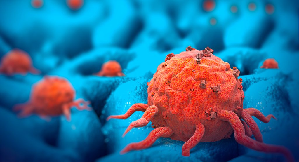 Ridurre l’incidenza di cancro al seno è possibile? Tumore al seno