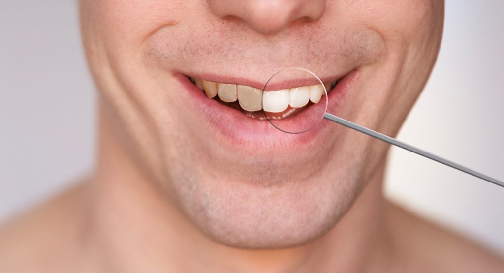 Sbiancamento dentale: come possiamo orientarci tra le pubblicità di prodotti che il mercato offre? Sbiancamento-dentale