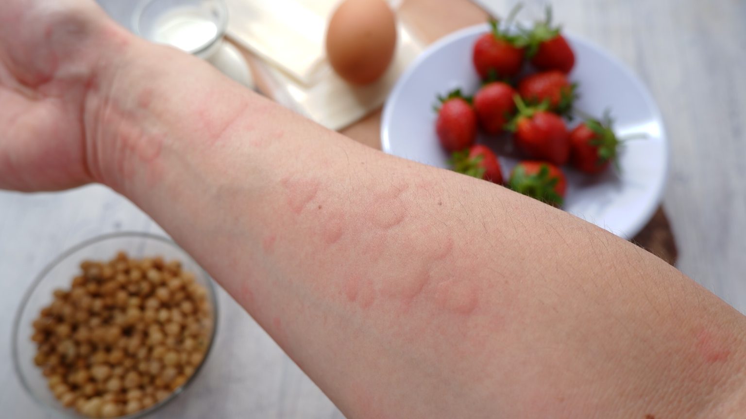 Le dermatiti e le loro possibili cause alimentari