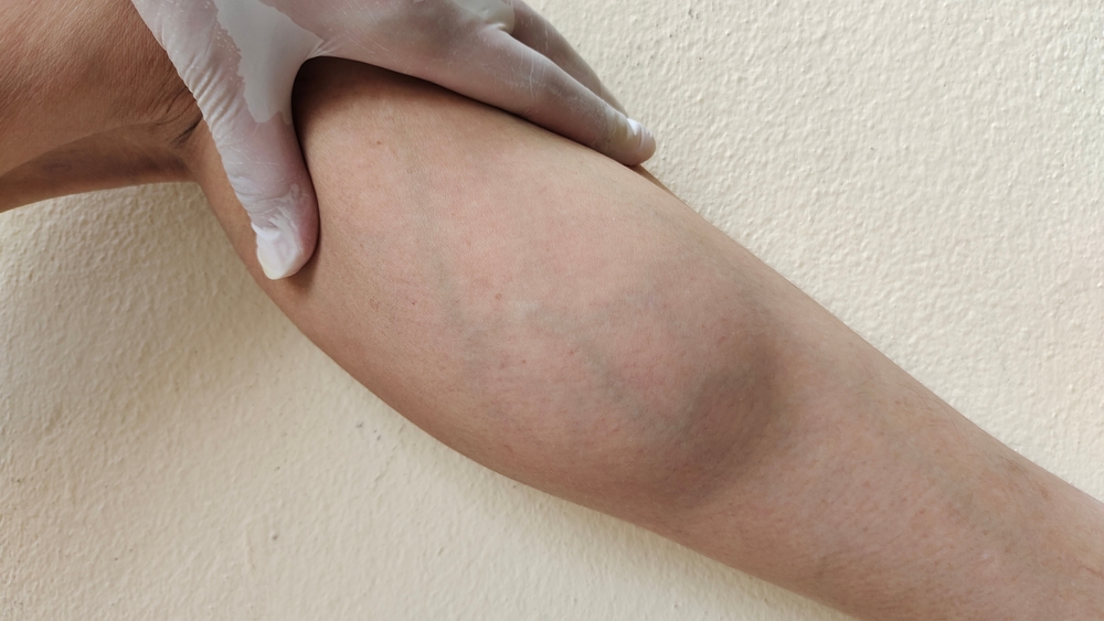 Lipedema: comprendere, riconoscere e gestire questa patologia sottodiagnosticata